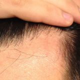 Can I convert vellus hair to terminal?